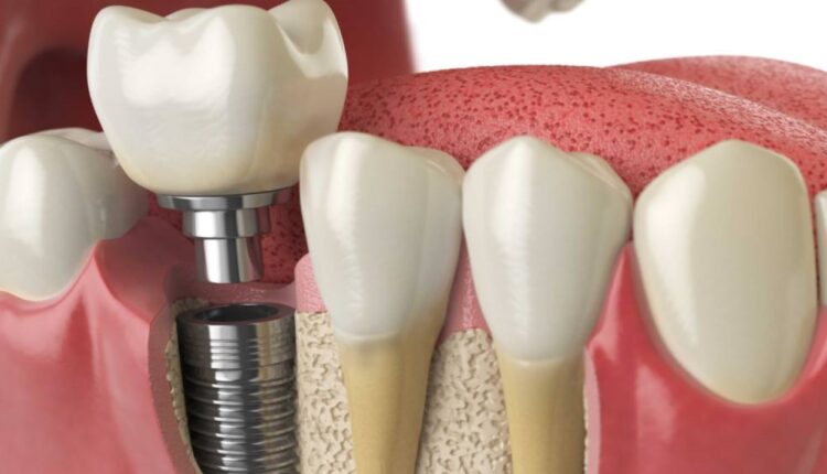 Dental İmplant Nedir