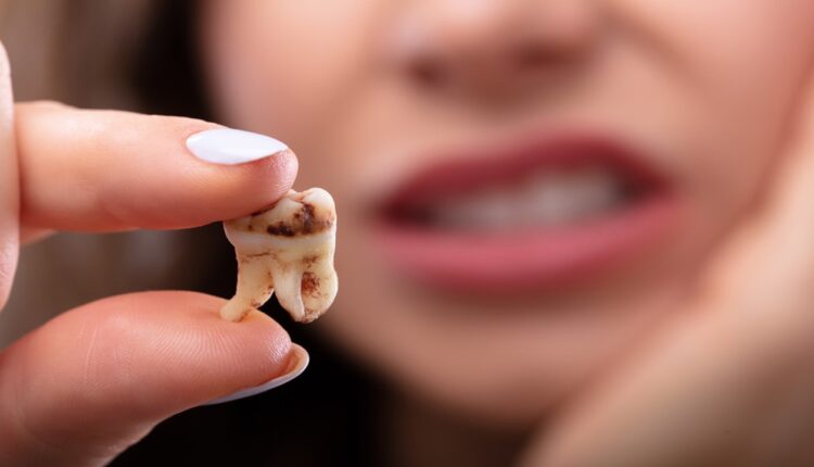 Diş Çürüğü Nedir ve Nasıl Tedavi Edilir